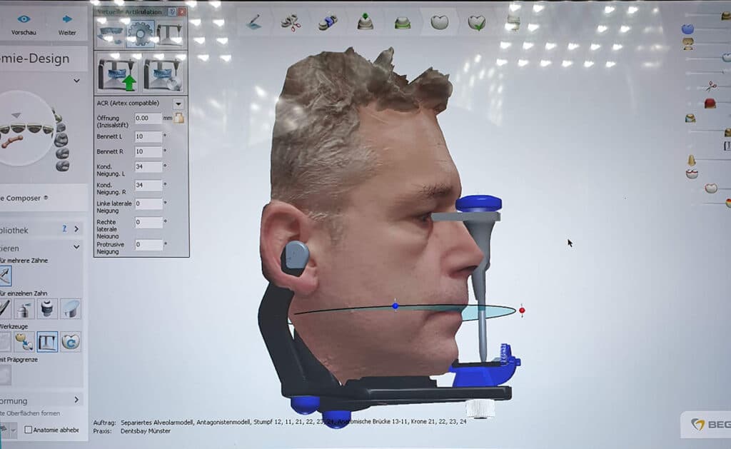 Gesichtsscan mit virtuellem Artikulator in exocad